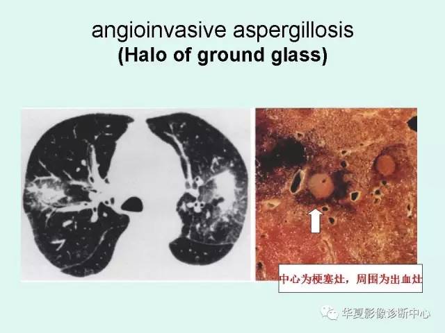 【病例】侵袭性肺曲霉菌病1例CT