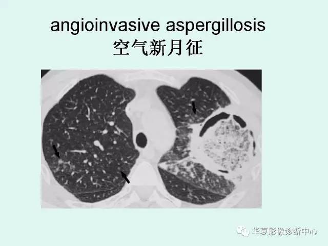 【病例】侵袭性肺曲霉菌病1例CT
