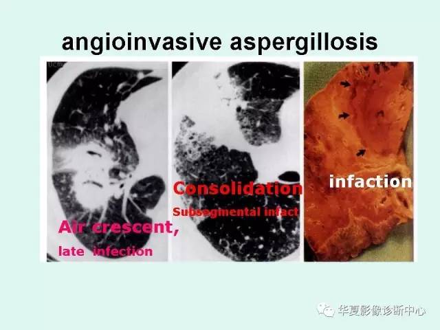 【病例】侵袭性肺曲霉菌病1例CT