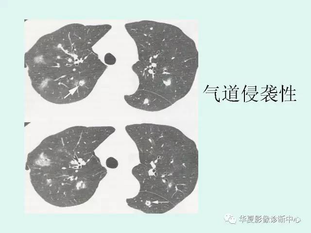 【病例】侵袭性肺曲霉菌病1例CT