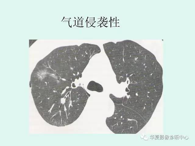 【病例】侵袭性肺曲霉菌病1例CT