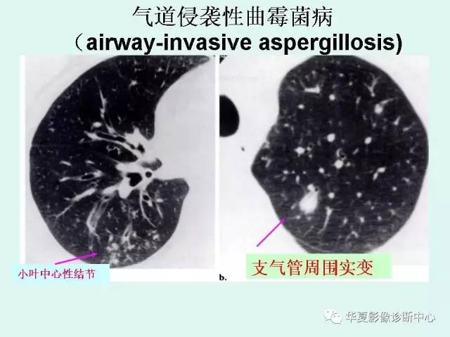 【病例】侵袭性肺曲霉菌病1例CT