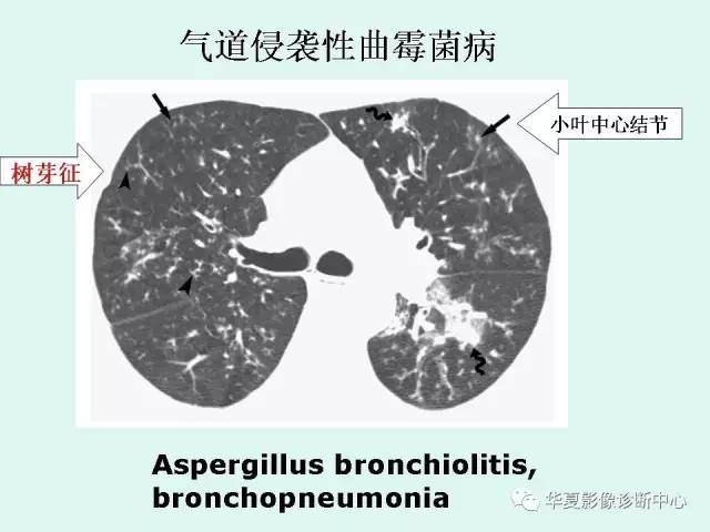 【病例】侵袭性肺曲霉菌病1例CT