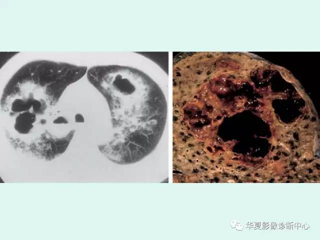 【病例】侵袭性肺曲霉菌病1例CT