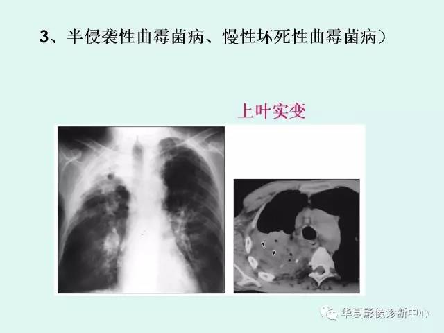【病例】侵袭性肺曲霉菌病1例CT