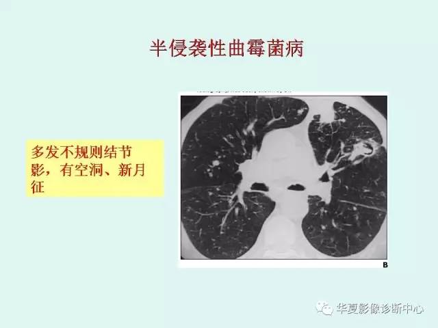 【病例】侵袭性肺曲霉菌病1例CT