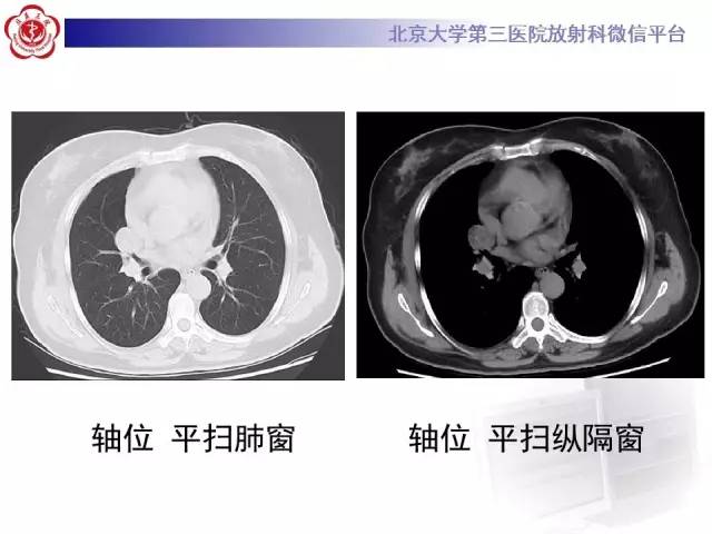 【病例】肺错构瘤1例CT影像表现
