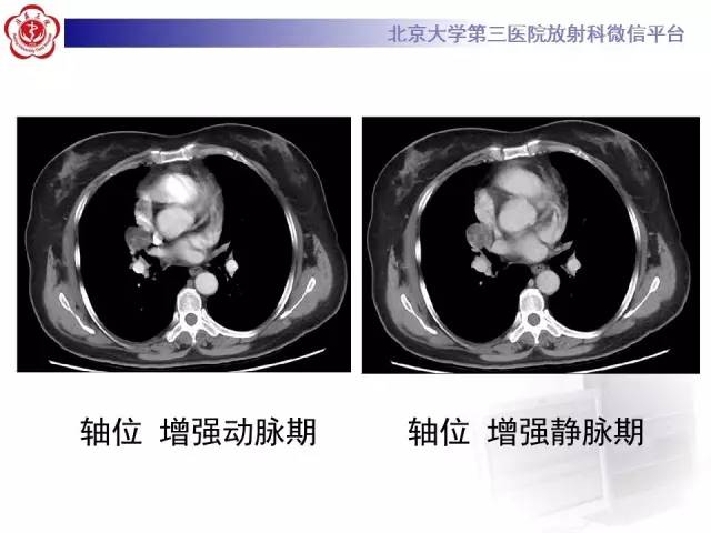 【病例】肺错构瘤1例CT影像表现