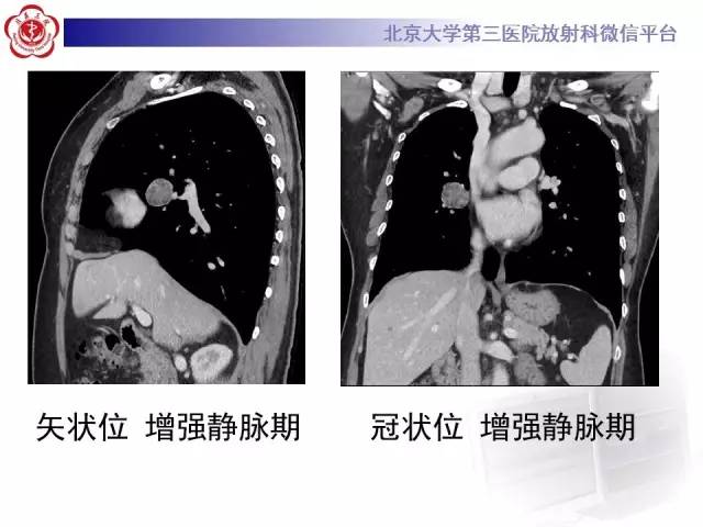 【病例】肺错构瘤1例CT影像表现