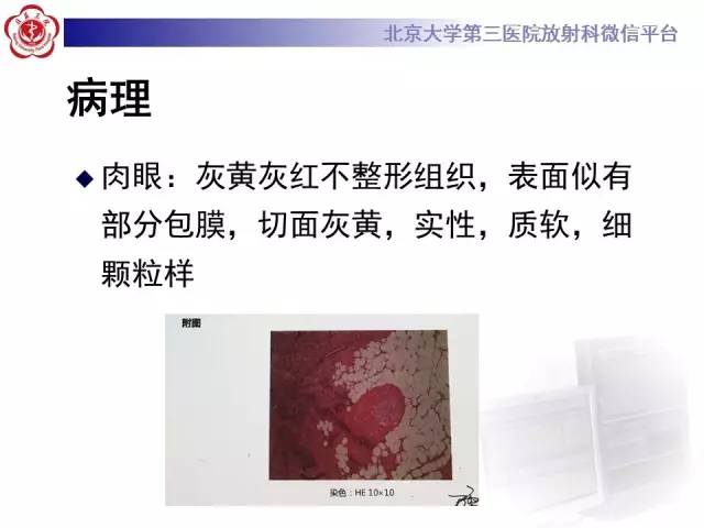 【病例】肺错构瘤1例CT影像表现