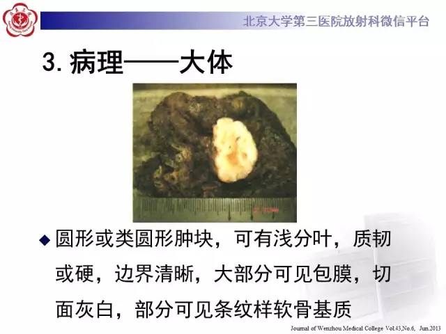 【病例】肺错构瘤1例CT影像表现