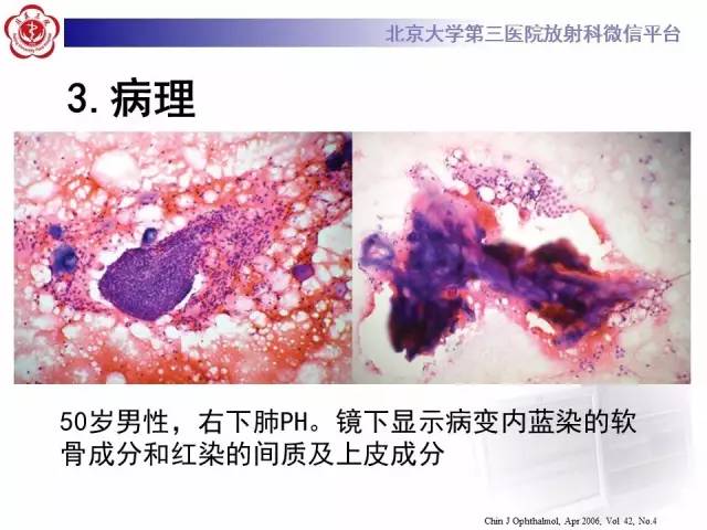 【病例】肺错构瘤1例CT影像表现