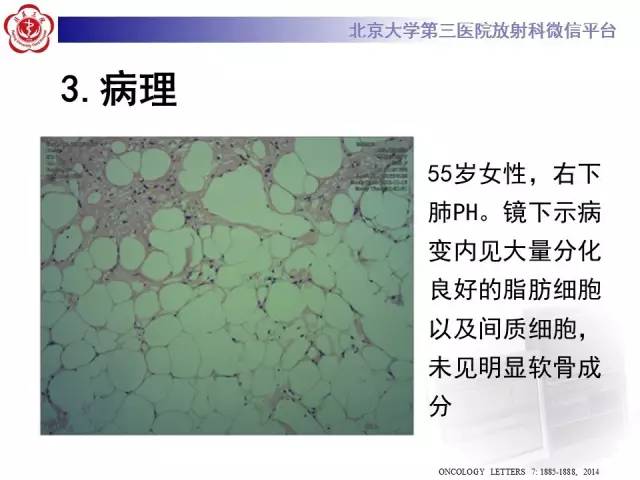 【病例】肺错构瘤1例CT影像表现