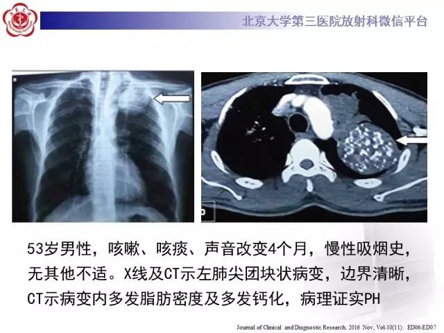 【病例】肺错构瘤1例CT影像表现