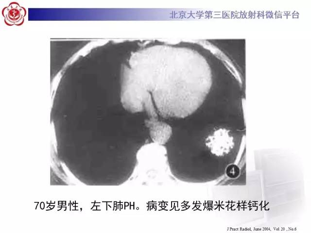 【病例】肺错构瘤1例CT影像表现