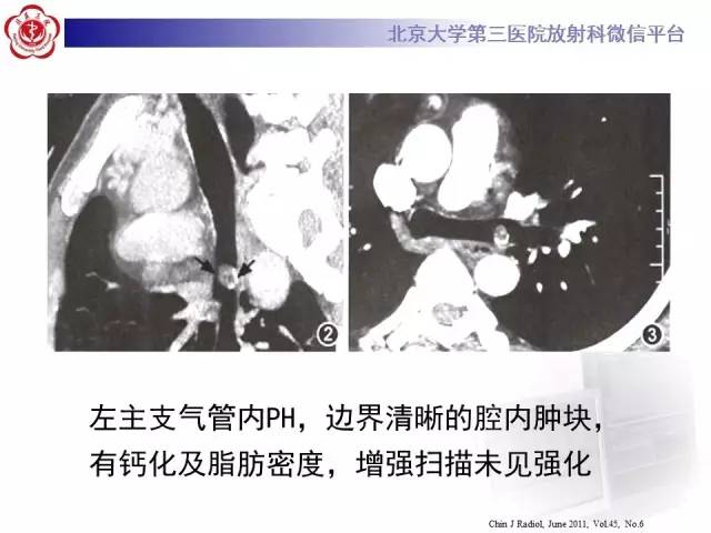 【病例】肺错构瘤1例CT影像表现