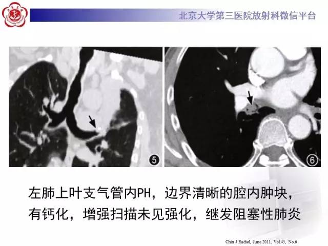 【病例】肺错构瘤1例CT影像表现