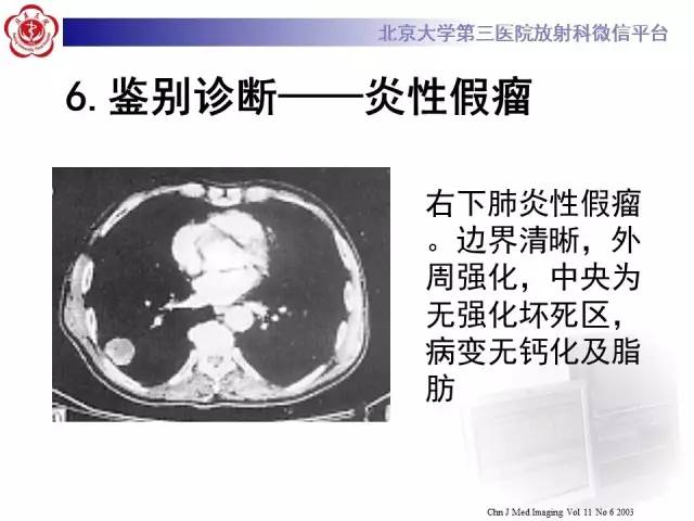 【病例】肺错构瘤1例CT影像表现