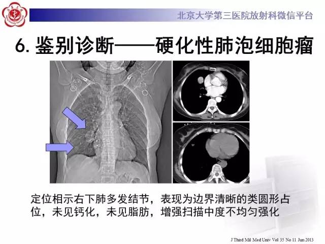 【病例】肺错构瘤1例CT影像表现