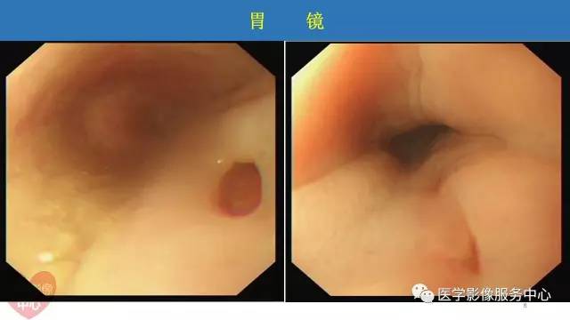 【病例】食管重复畸形1例X线CT