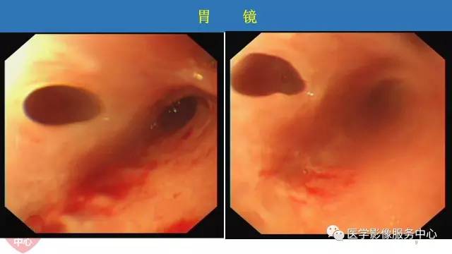 【病例】食管重复畸形1例X线CT