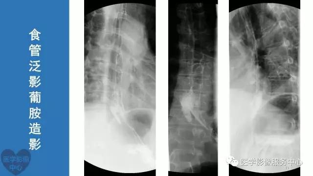 【病例】食管重复畸形1例X线CT