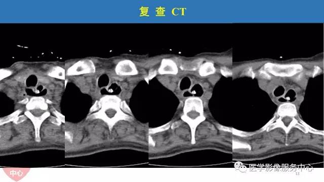 【病例】食管重复畸形1例X线CT