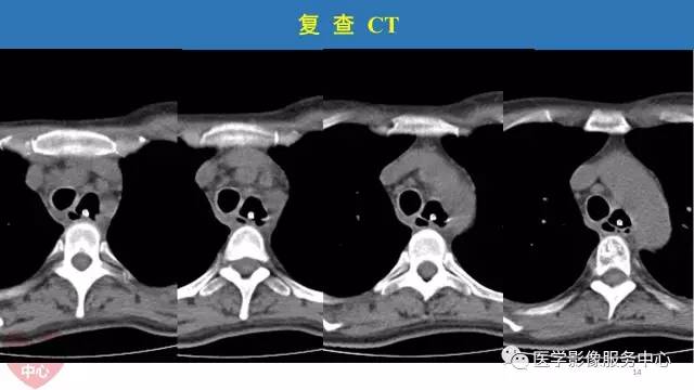 【病例】食管重复畸形1例X线CT