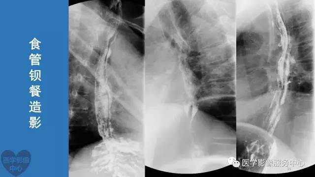 【病例】食管重复畸形1例X线CT