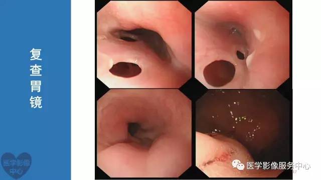 【病例】食管重复畸形1例X线CT