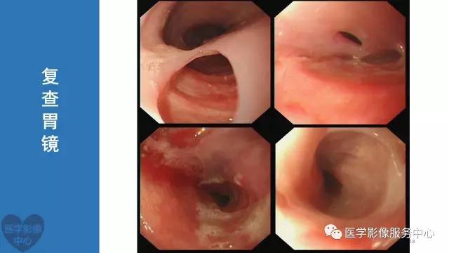 【病例】食管重复畸形1例X线CT