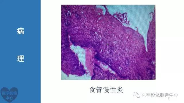 【病例】食管重复畸形1例X线CT