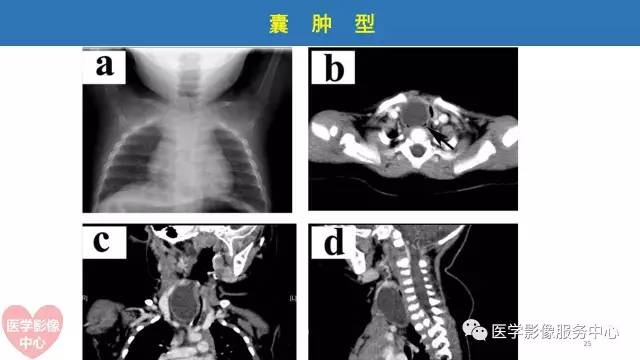 【病例】食管重复畸形1例X线CT