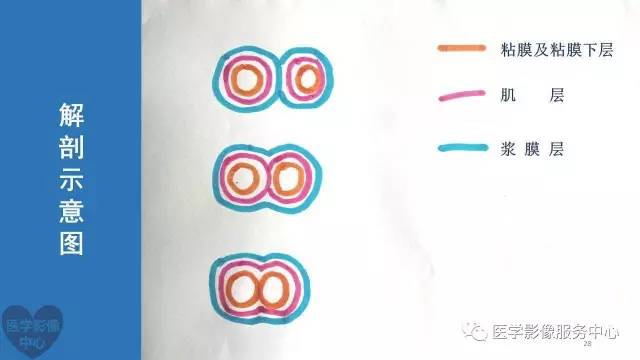 【病例】食管重复畸形1例X线CT