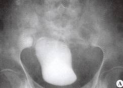 梨形膀胱(pear-shaped bladder) 梨形膀胱(pear-shaped bladder)