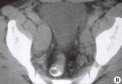 梨形膀胱(pear-shaped bladder) 梨形膀胱(pear-shaped bladder)
