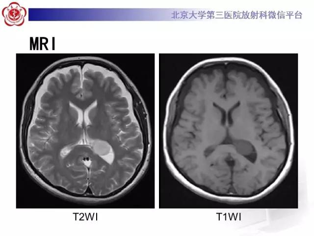 【病例】左侧脑室三角区脑膜瘤1例MR