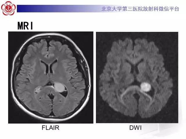 【病例】左侧脑室三角区脑膜瘤1例MR