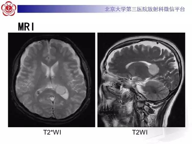 【病例】左侧脑室三角区脑膜瘤1例MR