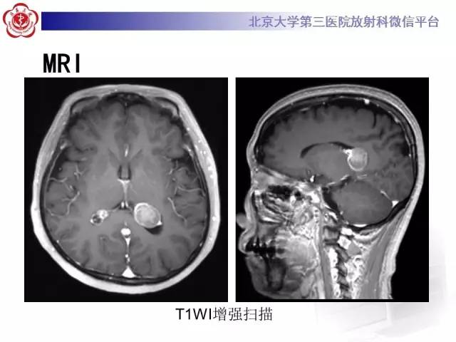 【病例】左侧脑室三角区脑膜瘤1例MR