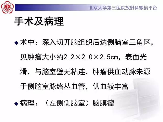 【病例】左侧脑室三角区脑膜瘤1例MR