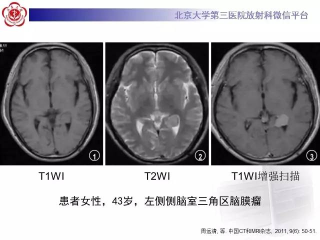【病例】左侧脑室三角区脑膜瘤1例MR