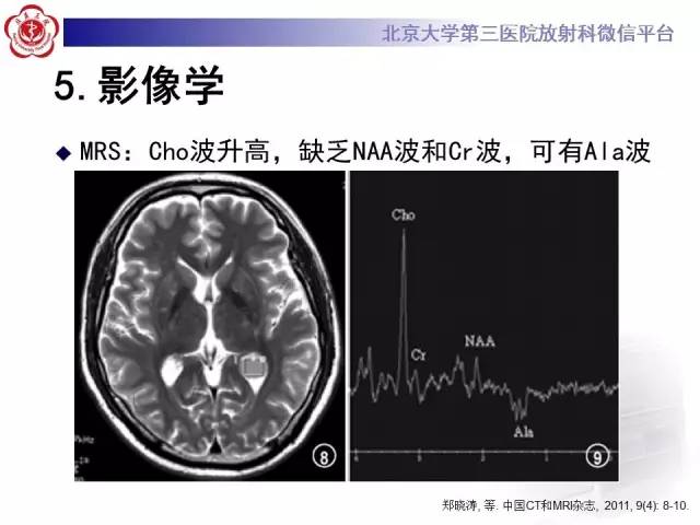 【病例】左侧脑室三角区脑膜瘤1例MR