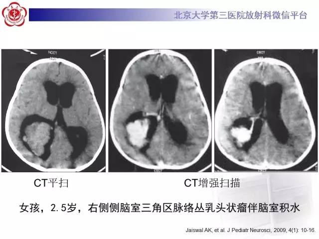 【病例】左侧脑室三角区脑膜瘤1例MR