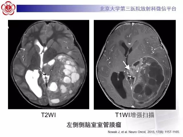 【病例】左侧脑室三角区脑膜瘤1例MR