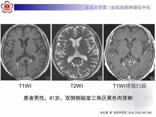 【病例】左侧脑室三角区脑膜瘤1例MR