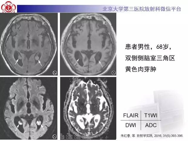 【病例】左侧脑室三角区脑膜瘤1例MR