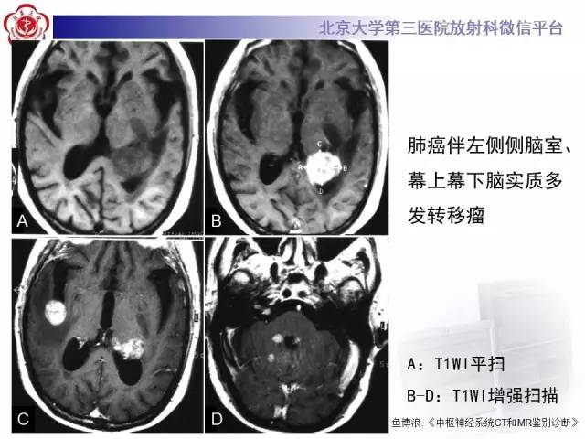 【病例】左侧脑室三角区脑膜瘤1例MR