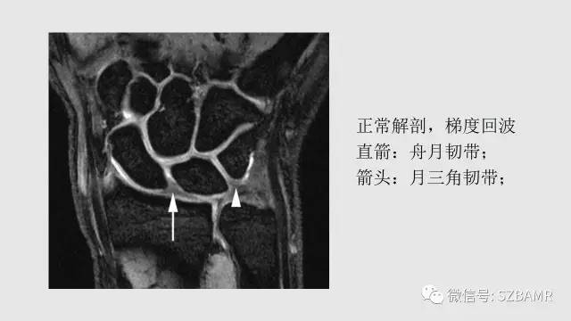 【PPT】腕、手磁共振成像正常解剖与变异