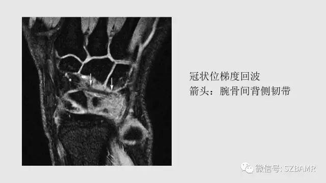 【PPT】腕、手磁共振成像正常解剖与变异